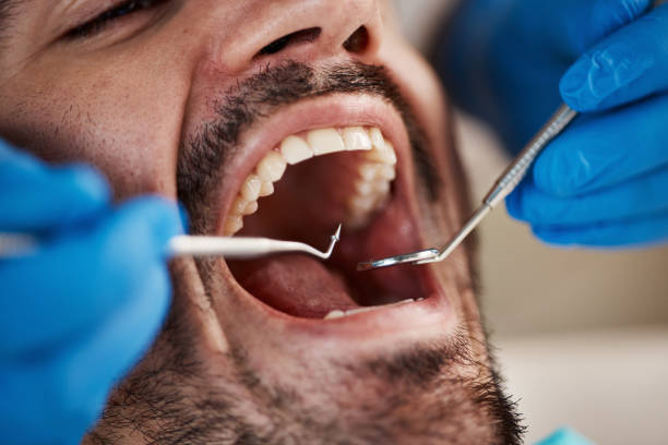 Best Emergency Dental Care for Broken or Chipped Teeth in Endwell, NY