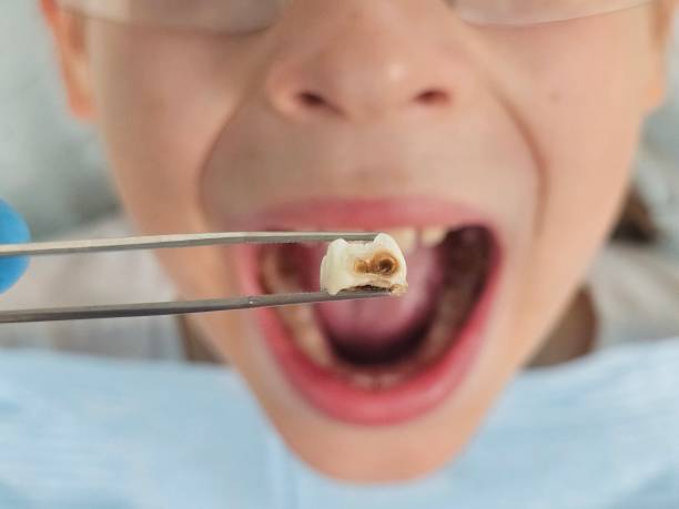 Best Emergency Tooth Extraction in Endwell, NY
